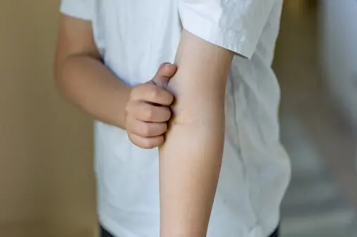 Symptoms of an allergic reaction